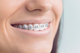 doktoroo-traditional-braces
